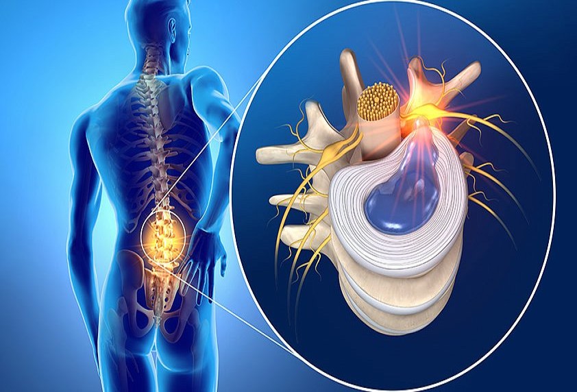 Bel Fıtığı Neden Oluşur?