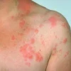 Postherpetik Nevralji Nedir? Belirtileri ve Tedavisi