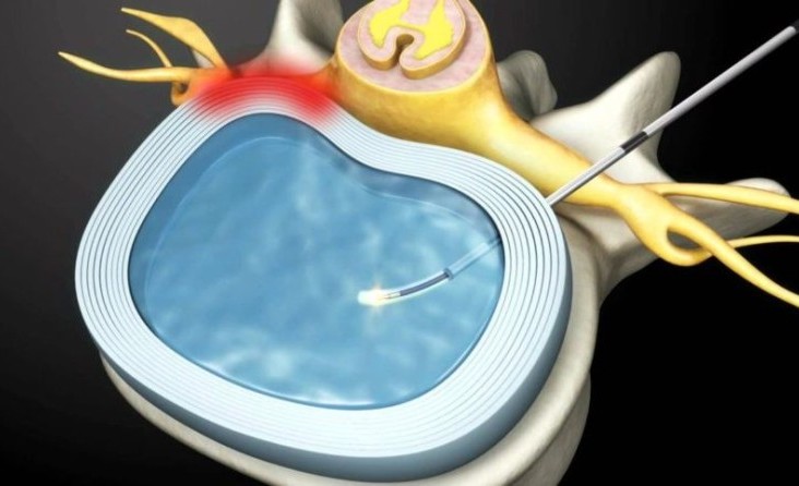 Nükleoplasti Nedir?