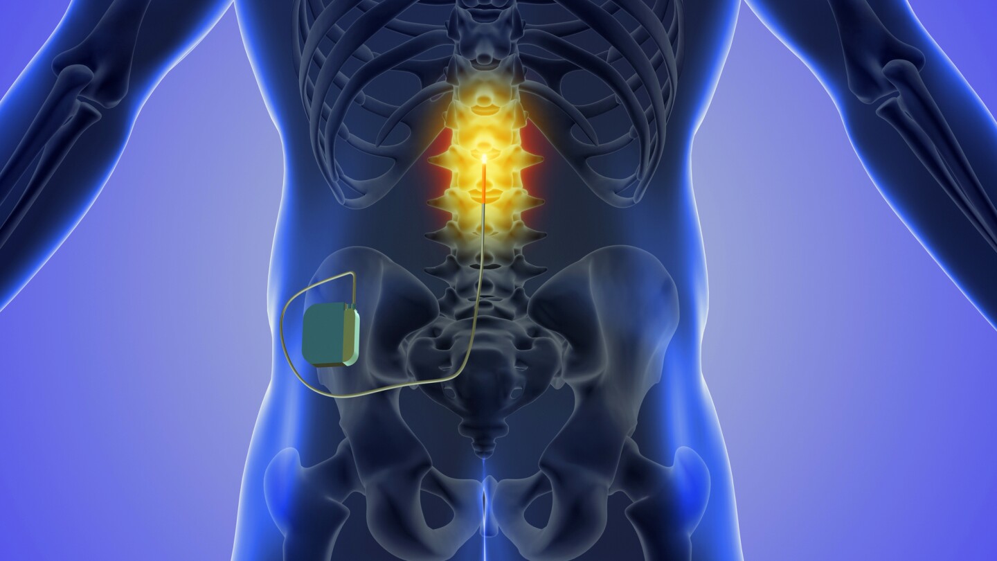 Ağrı Pili (Spinal Kord Stimülasyonu) 